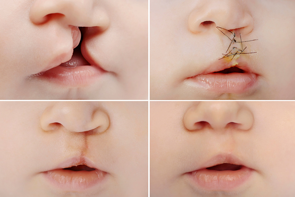 cleft lip and palate examples